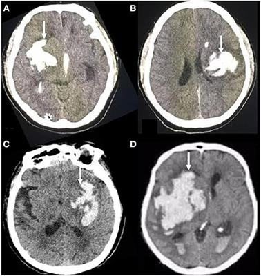 Irregular-Shaped Hematoma Predicts Postoperative Rehemorrhage After Stereotactic Minimally Invasive Surgery for Intracerebral Hemorrhage